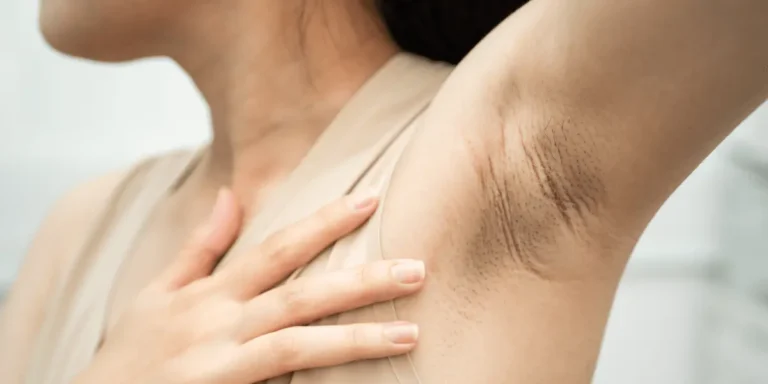 O que causa manchas escuras nas axilas e virilhas? O que causa manchas escuras nas axilas e virilhas